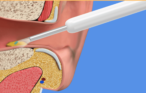 Camera pour oreille Wifi USB HD, nettoyeur auriculaire, vision en temps réel, outil d’inspection pratique et sûr