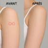 Stylo laser à lumière bleue pour taches, cicatrices et tatouages