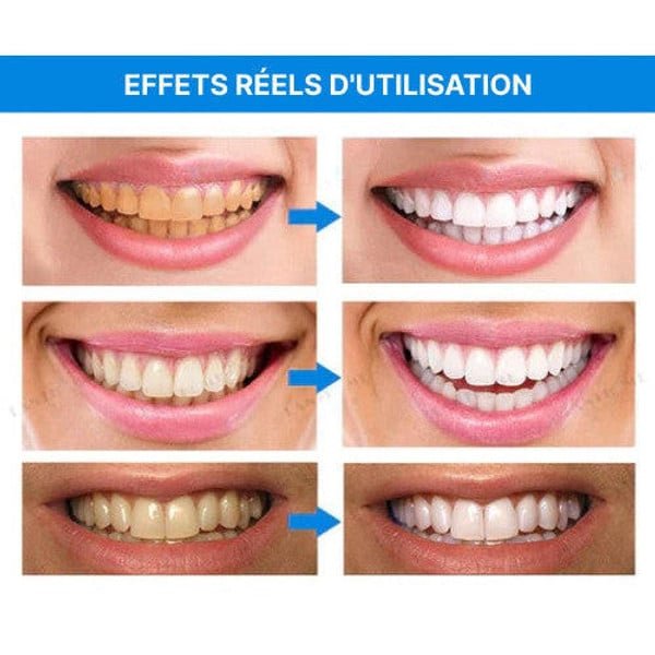 Stylo Blanchisseur de Dents – White Teeth