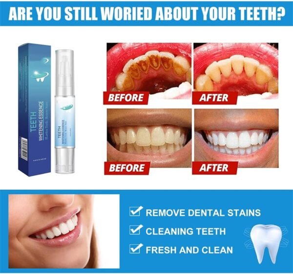 Stylo Blanchisseur de Dents – White Teeth