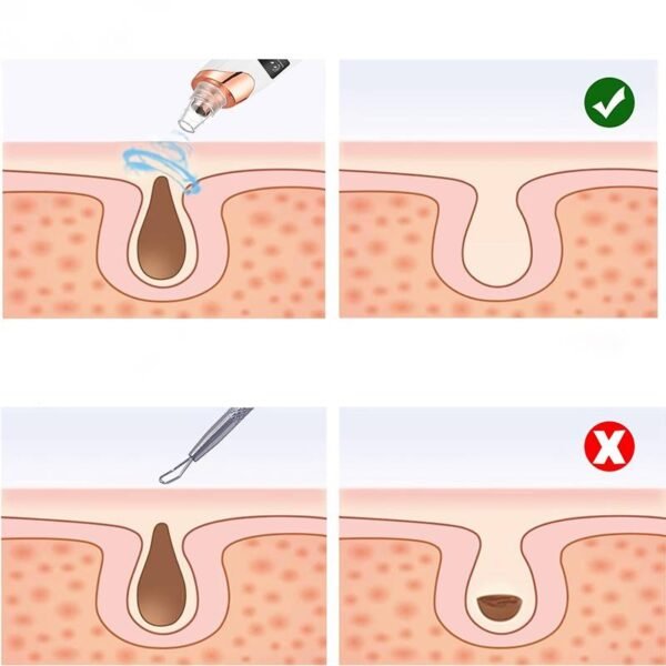 Aspirateur à Points Noirs | Nettoyeur de pores FaceCare