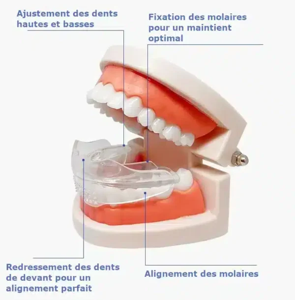 Gouttière de réalignement dentaire invisible