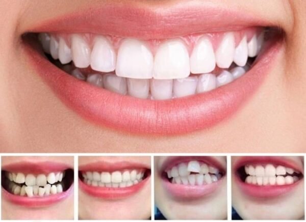 Gouttière de réalignement dentaire invisible