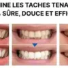 Stylo Blanchisseur de Dents – White Teeth