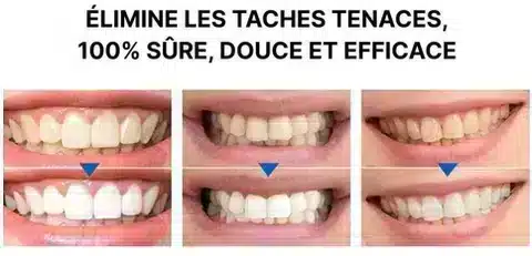 Stylo Blanchisseur de Dents – White Teeth